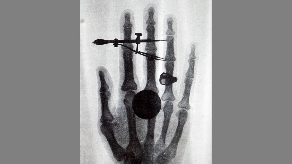 Foto zeigt ein frühes Röntgenbild