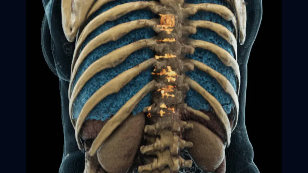 Deep learning methods help discover bone metastases, which can be overlooked in clinical routine. CT dataset courtesy of Radboudumc, Nijmegen, NL.